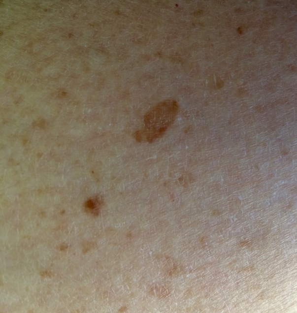 Seborrheic keratoses - a common skin growth.